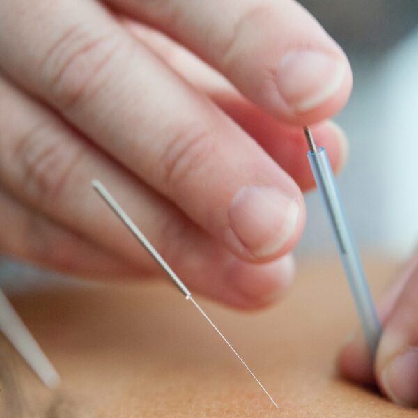 Acupuncture