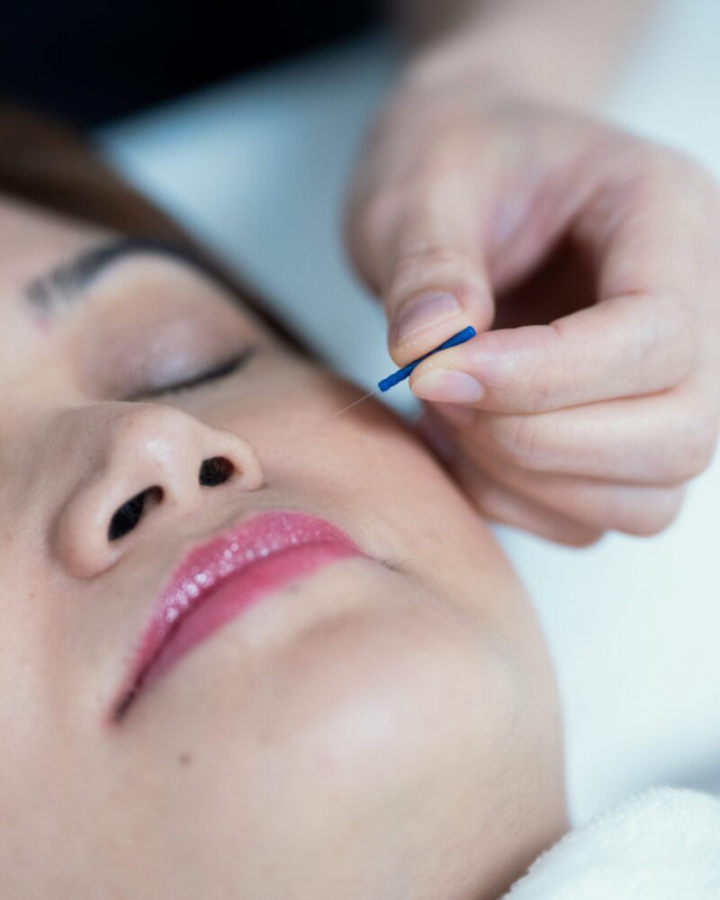 Facial acupuncture