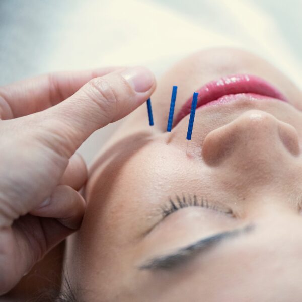 Facial acupuncture_The Ark